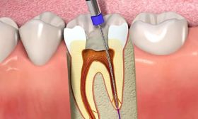 Tooth Extraction Treatment in Navi Mumbai