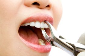 Tooth Extraction Services in Dubai