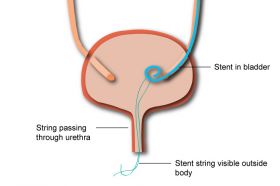 Ureteral stent 