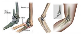 Total Elbow Replacement