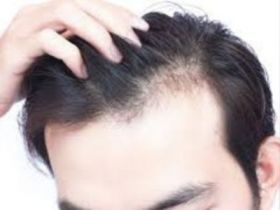 Hair Loss Treatment in Lucknow For Men