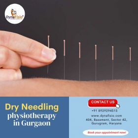 Dry Needling Therapy