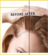 Hair Fall Treatment