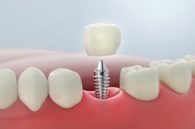 Dental Implants Arlington VA