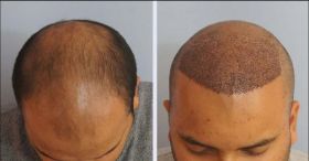 Hair Transplant