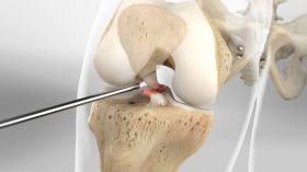 ACL Repair