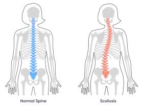  Scoliosis surgery Union, NJ