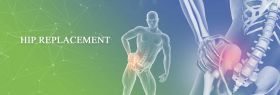 Hip Replacement