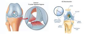 Ligament Injuries