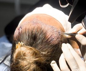 Hair Transplant