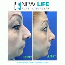 Enhance Your Looks via Cosmetic Surgery 
