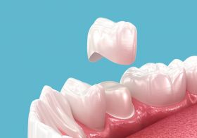 Dental Crowns Arlington