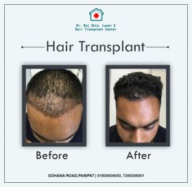 Dr.Raj Hair Transplant