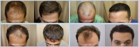 FUE Hair Transplant Specialists