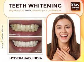 Teeth Whitening 