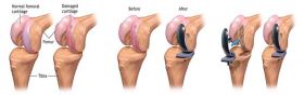 Painless & Minimal-Stitch Knee Replacement