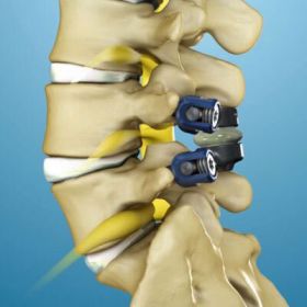 Spinal Stenosis Surgery - Bronx, NY