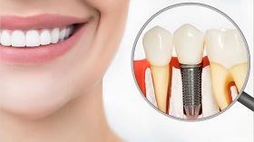 DENTAL IMPLANTS