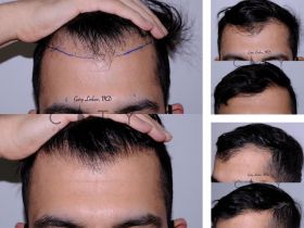 Hair Transplant NYC