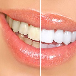 Cosmetic Tooth Fillings