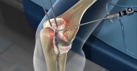 Elbow Arthroscopy