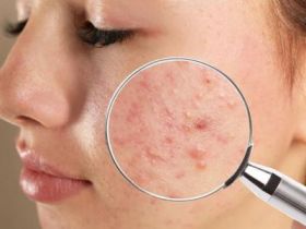 Acne Treatment in Lucknow