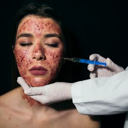 Vampire Facial Melbourne