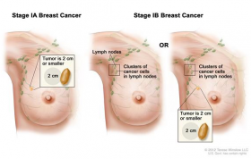 Breast cancer surgery in Ahmedabad 
