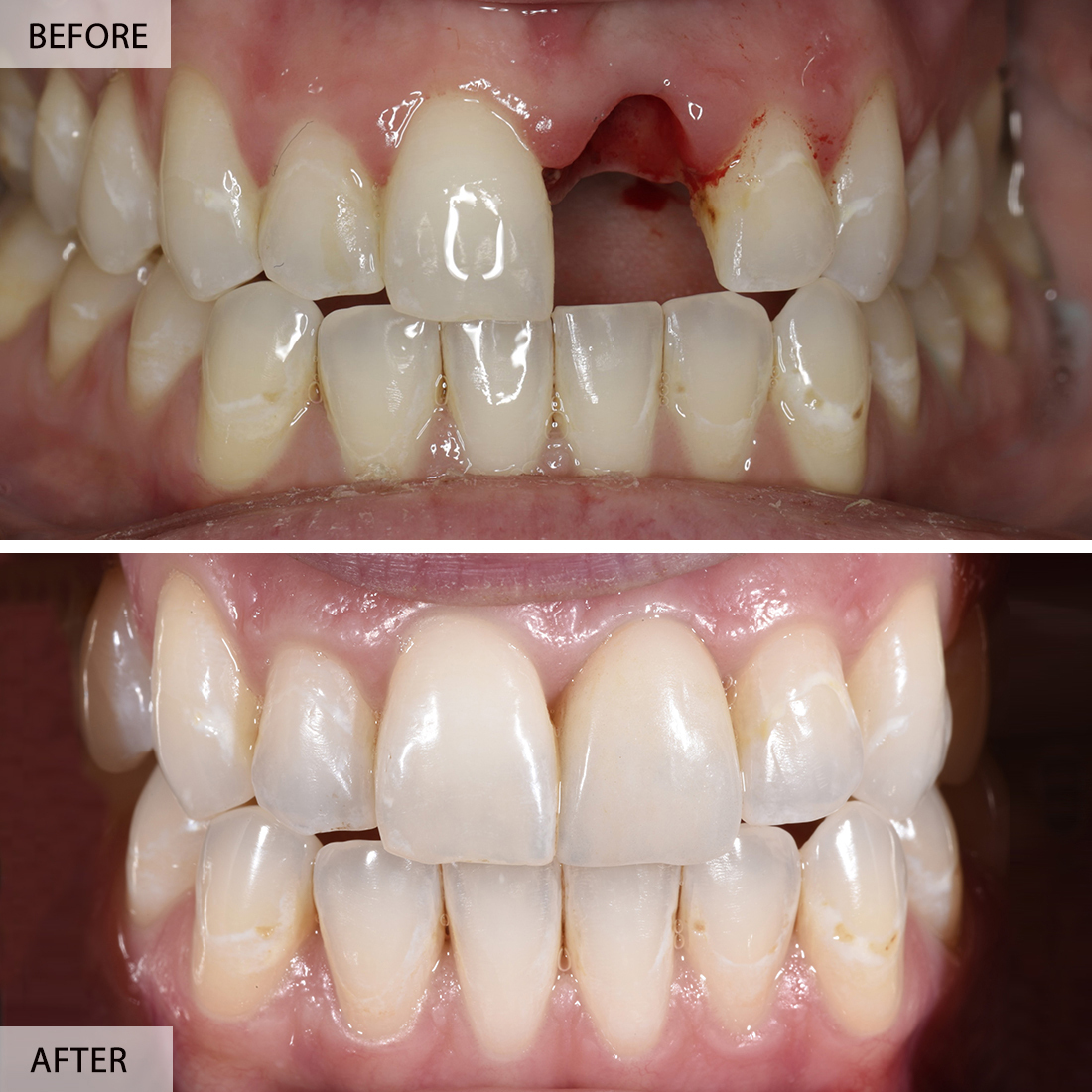 Dental Implant