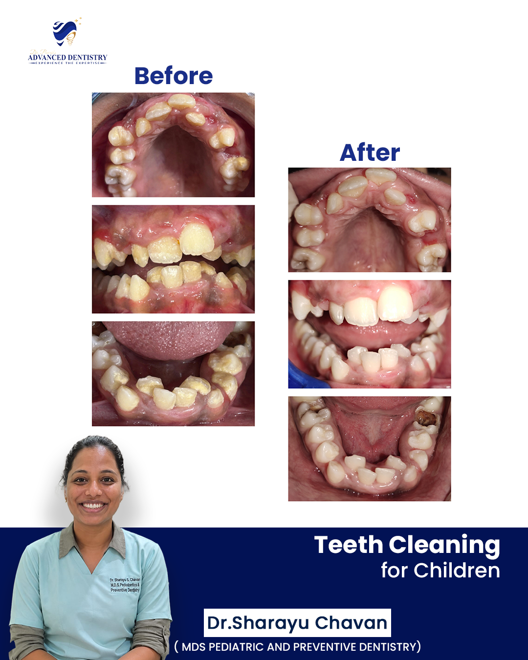 Teeth Cleaning for Children