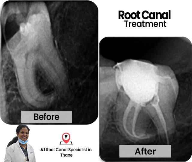 Root Canal Treatment
