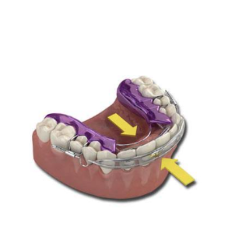 Inman Aligner