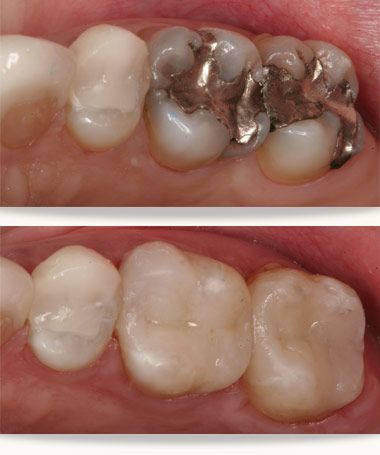 Tooth Colored Filling