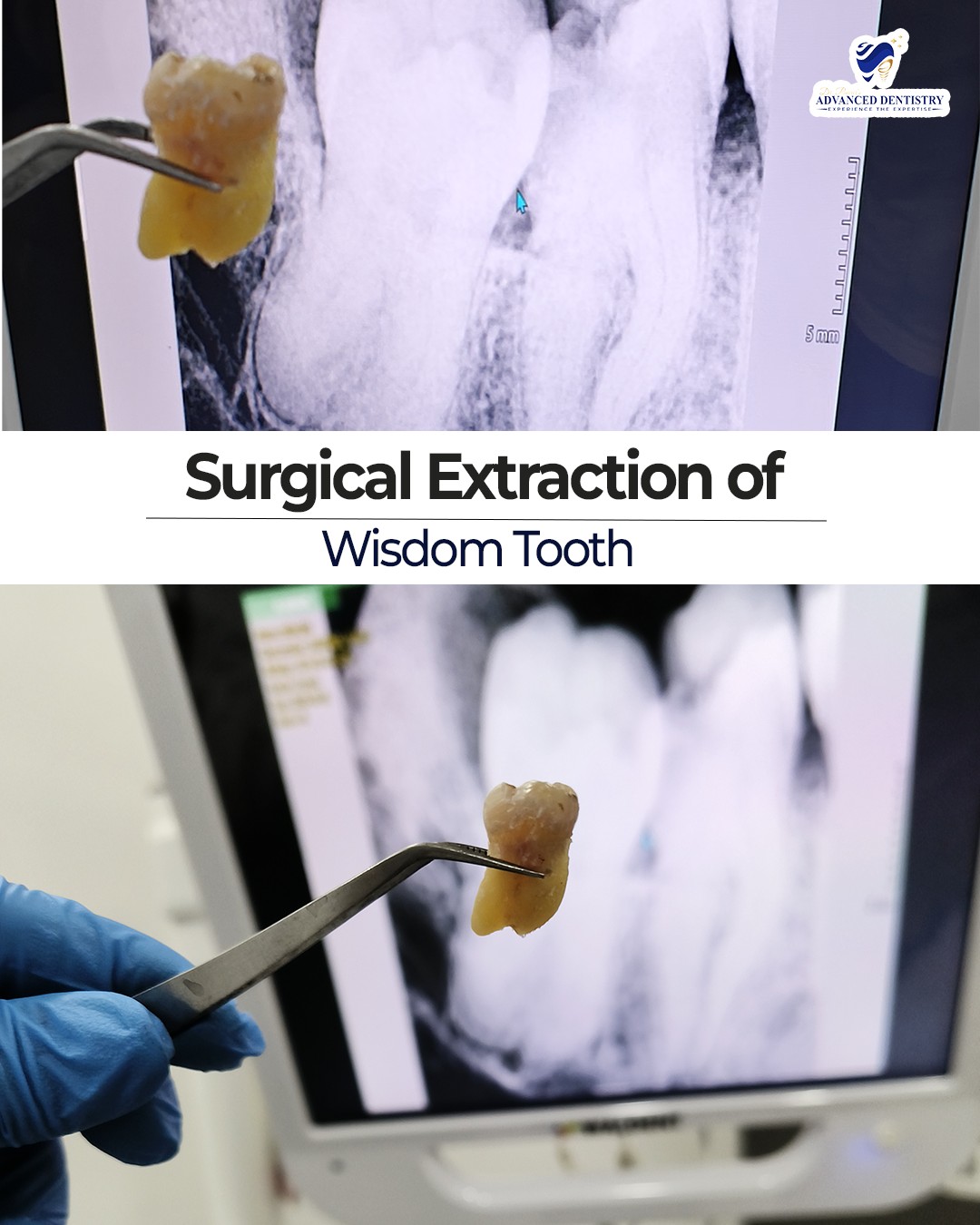 Surgical Extraction